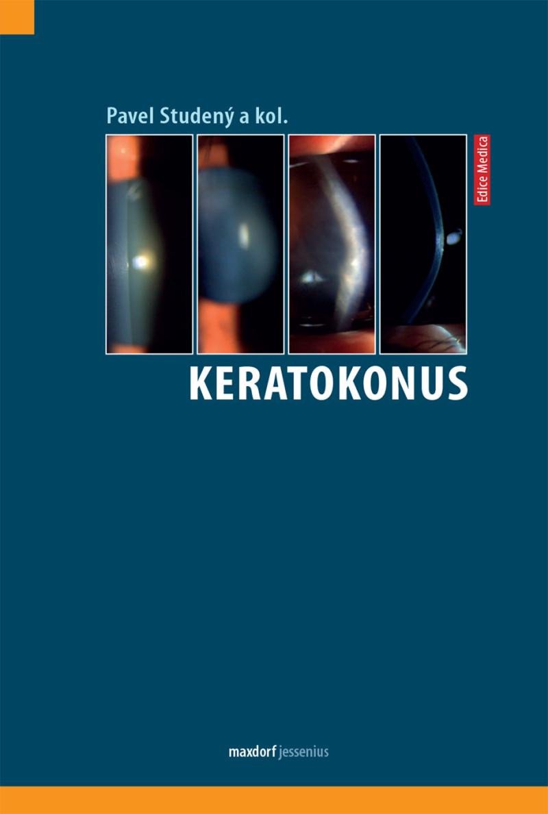 KERATOKONUS